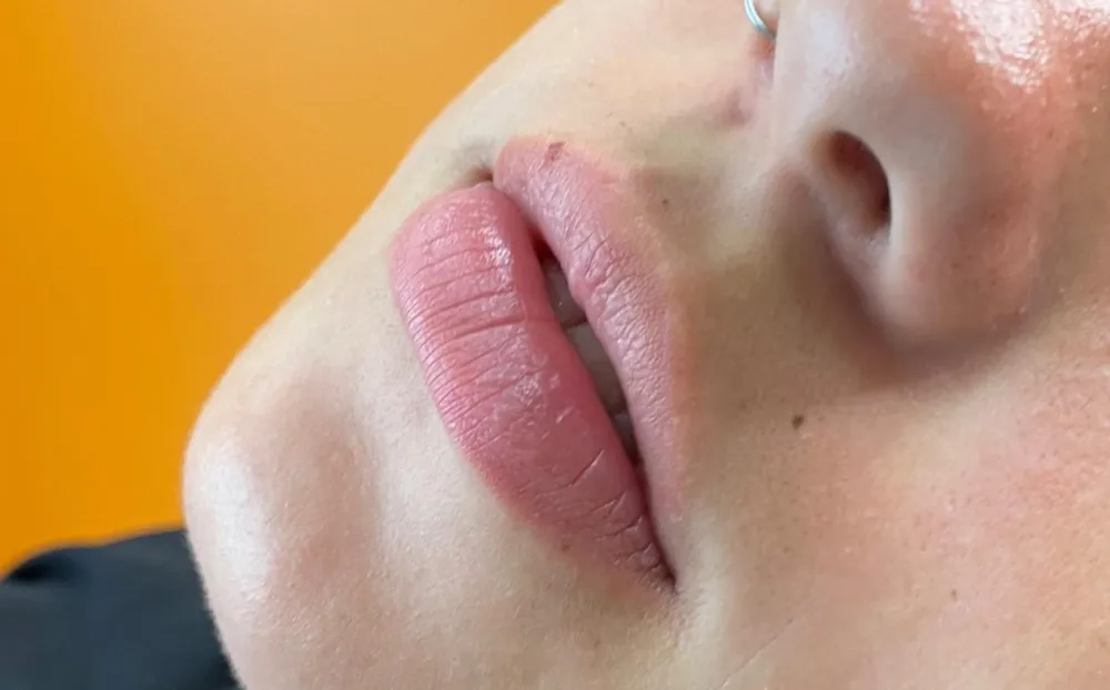 Lábios antes do preenchimento labial